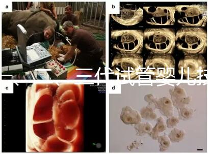 一、二、三代試管嬰兒技術的區別，看完你就知道了！