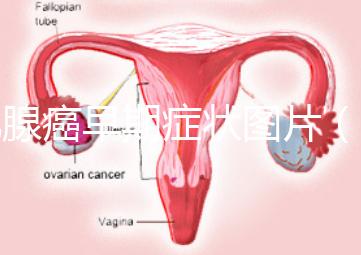 乳腺癌早期癥狀圖片（初期人乳頭瘤圖片）