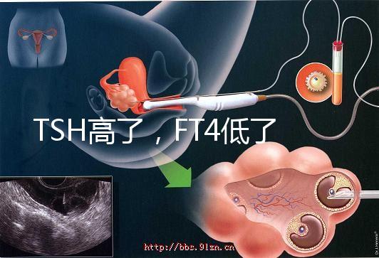TSH高了，FT4低了，需要補碘嗎？